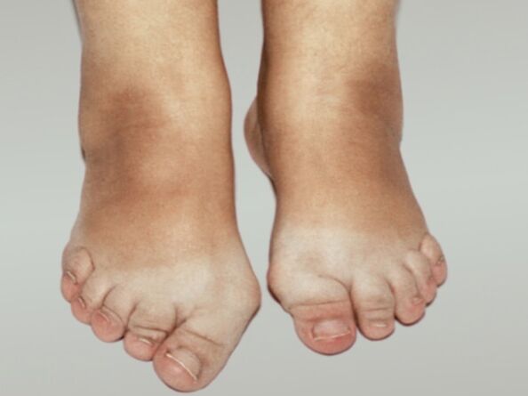 Artrose do pé con deformación severa dos dedos