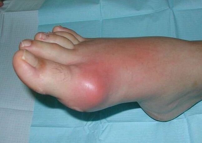 Cadro clínico da artrite do pé - inchazo e inflamación