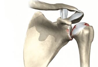 Articulación do ombreiro afectada por artrose
