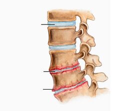 Osteocondrose