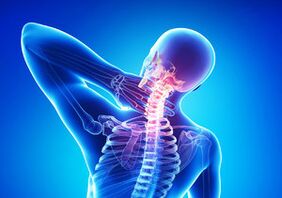 Signos de osteocondrose cervical