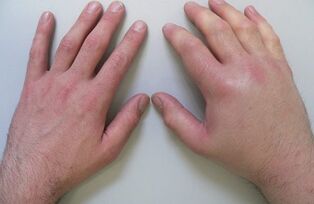 artralxia como causa de dor nas articulacións dos dedos