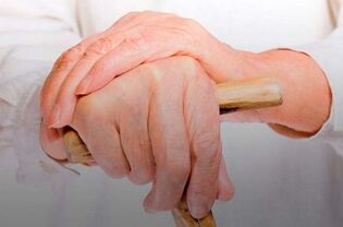 dor nas articulacións dos dedos con artrite reumatoide