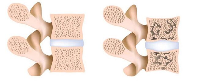osteoporose a eliminación do calcio dos ósos