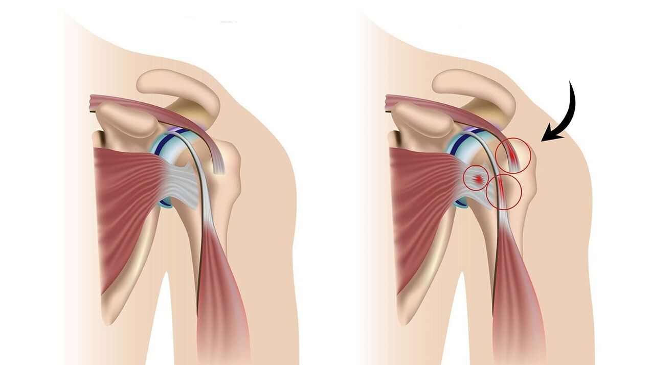 a inflamación do tecido brando arredor da articulación provoca unha forte dor