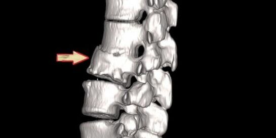 patoloxía da columna vertebral como causa de dores nas costas