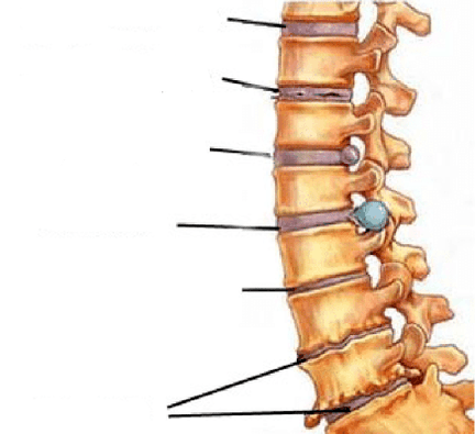 etapas do desenvolvemento da osteocondrose da columna vertebral