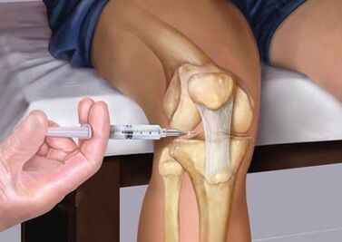 Inxección na articulación