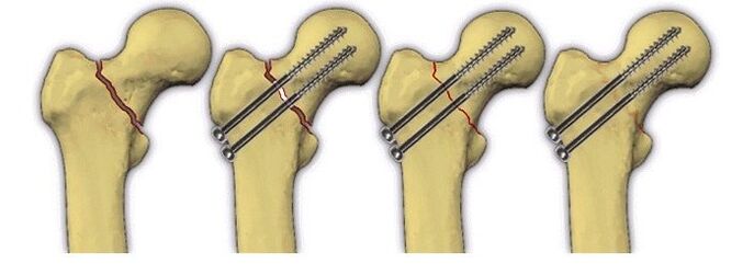 fixación do corpo óseo con alfinetes para a dor na articulación da cadeira