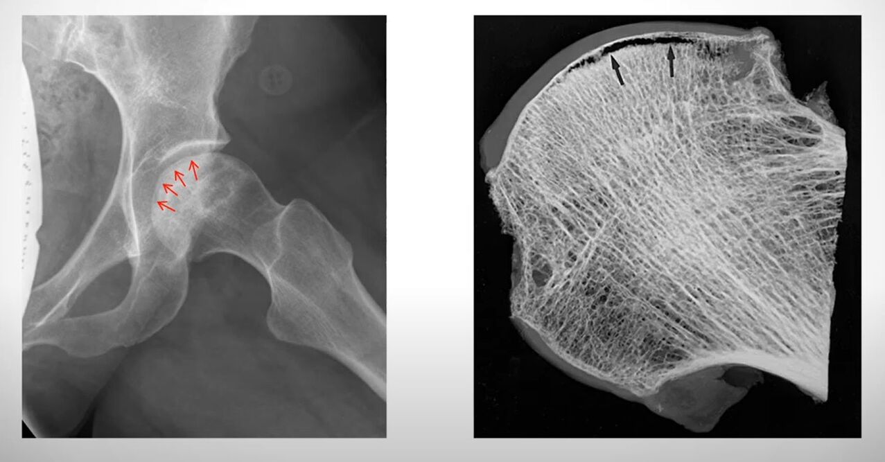 Radiografía da cabeza femoral afectada por necrose aséptica